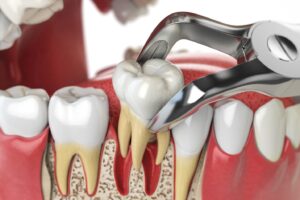 Digital rendering of dental tool removing tooth.